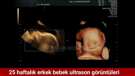erkek bebek ultrasonda nasıl durur